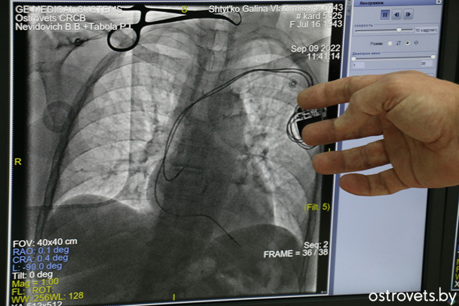 В Островце пациенту установили кардиостимулятор – такая операция в ЦРКБ проведена впервые